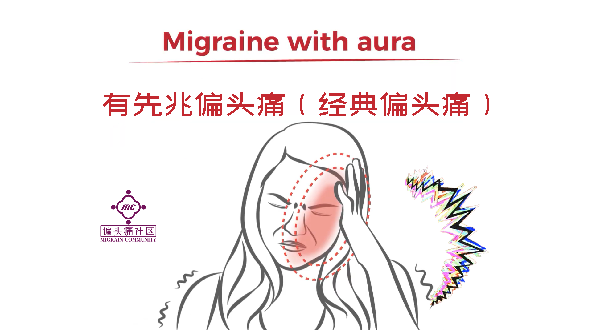 有先兆型偏头痛(经典偏头痛)