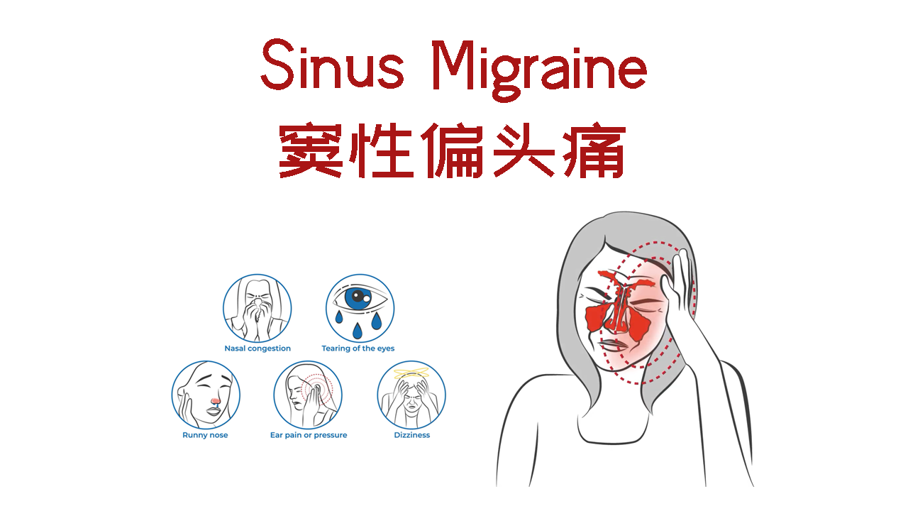 窦性偏头痛