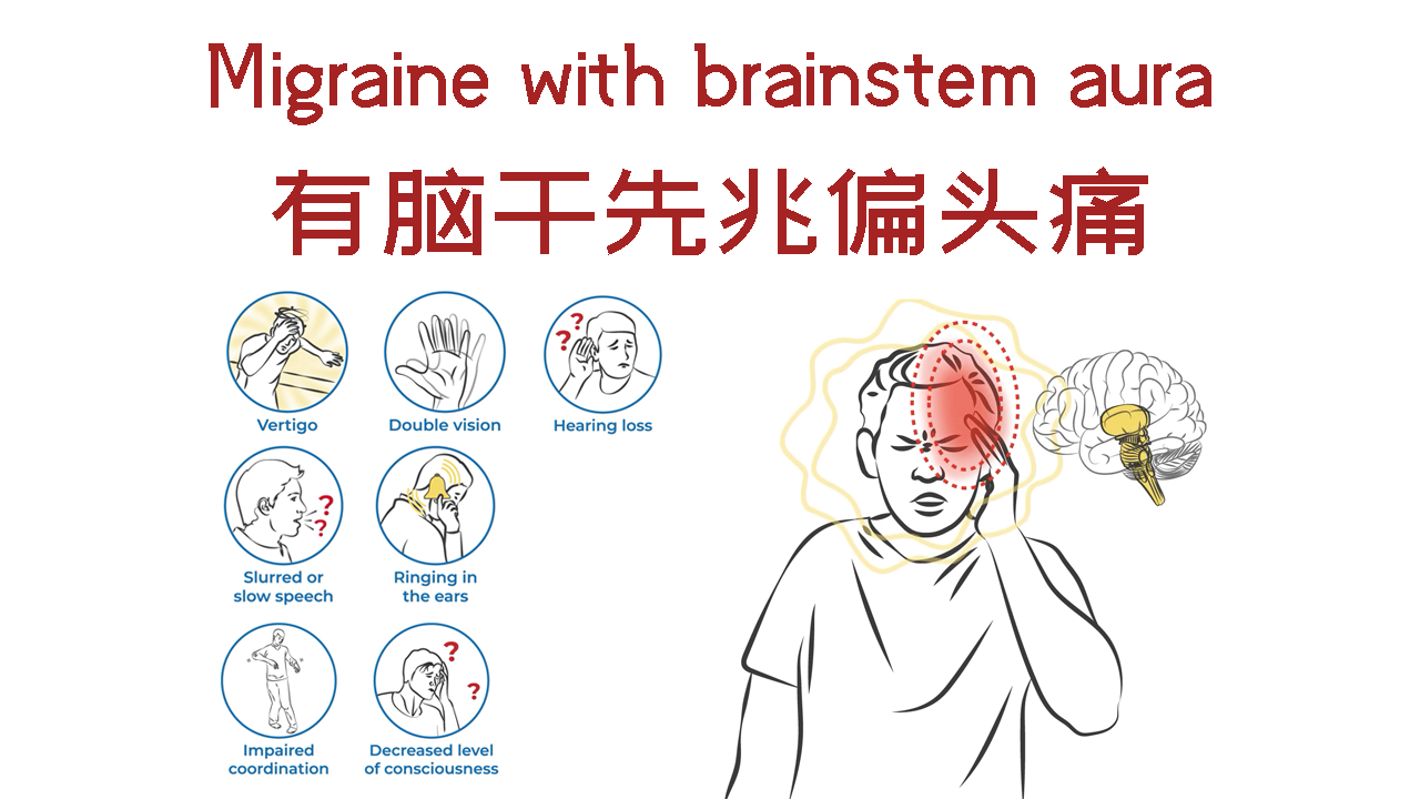有脑干先兆偏头痛(基底动脉型偏头痛)
