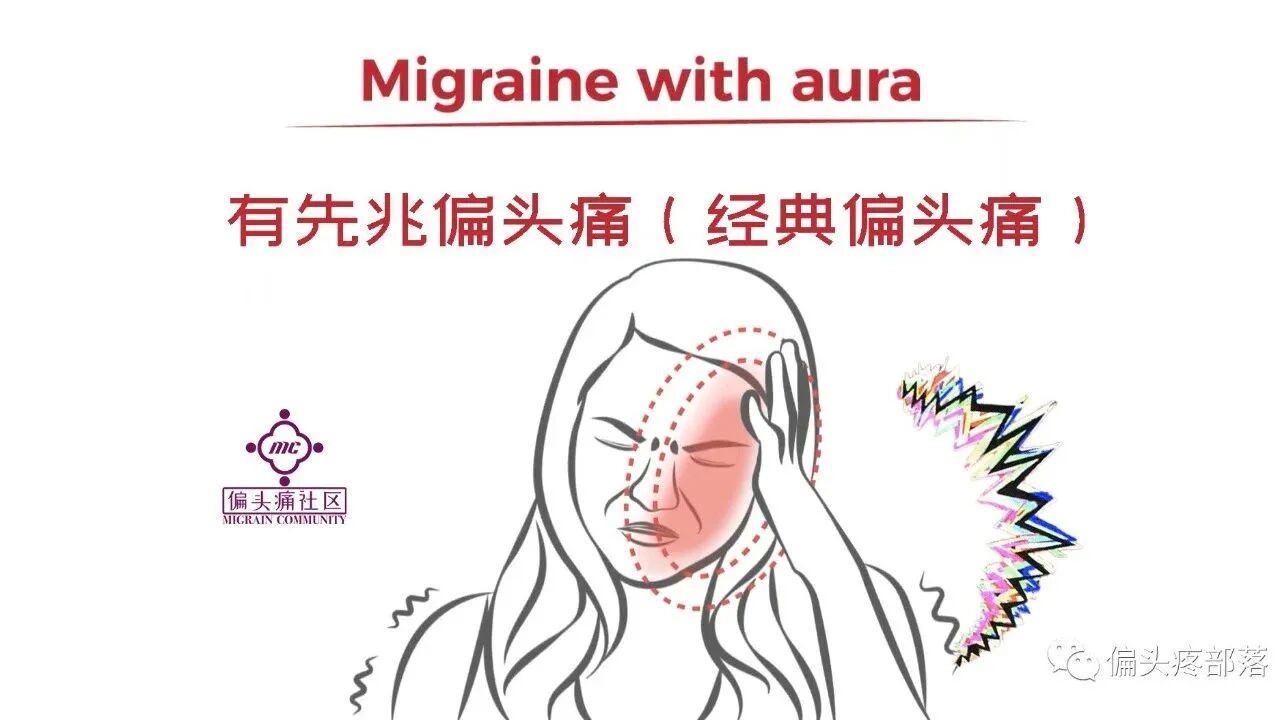 有先兆型偏头痛(经典偏头痛)